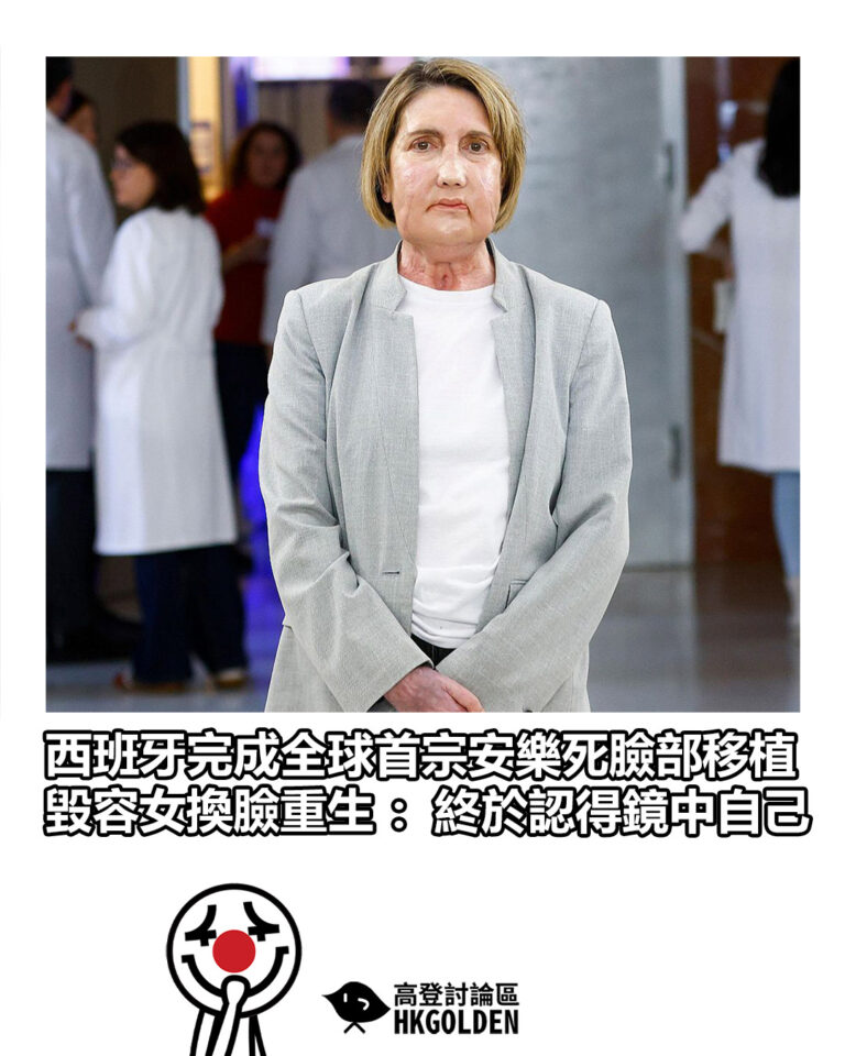 【西班牙完成全球首宗安樂死臉部移植 毀容女換臉重生：終於認得鏡中自己】