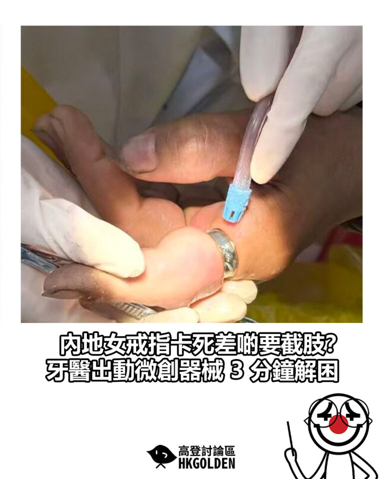 【內地女戒指卡死差啲要截肢? 牙醫出動微創器械 3 分鐘解困】 【內地女戒指卡死差啲要截肢? 牙醫出動微創器械 3 分鐘解困】