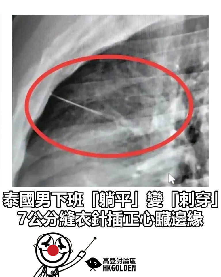 【泰國男下班「躺平」變「刺穿」 7公分縫衣針插正心臟邊緣】 【泰國男下班「躺平」變「刺穿」 7公分縫衣針插正心臟邊緣】