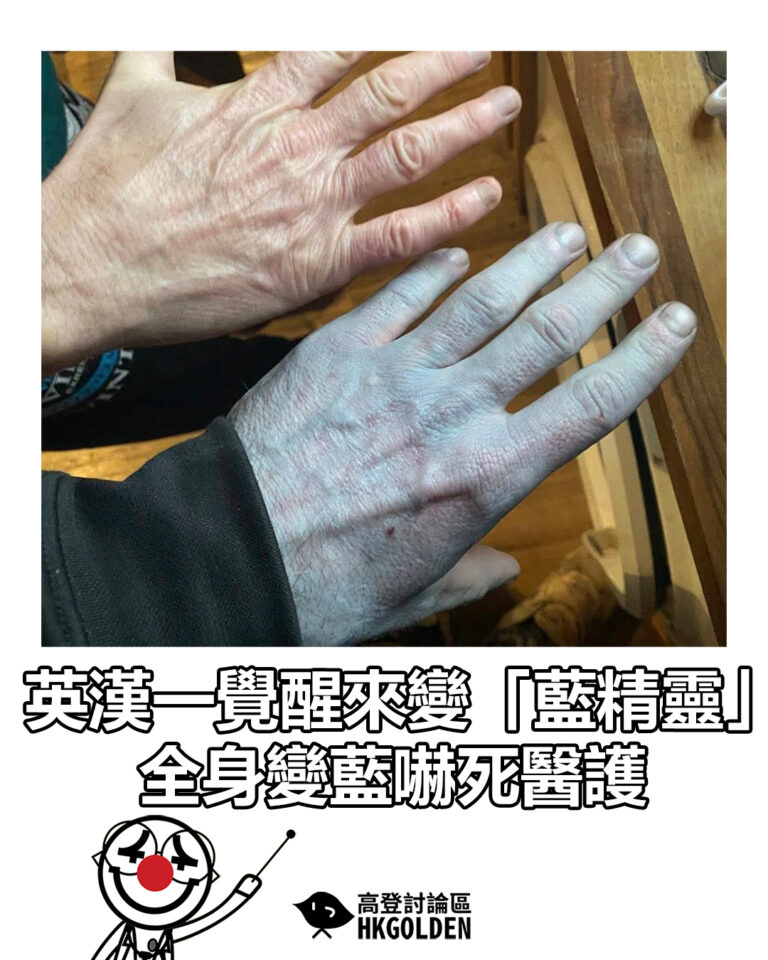 【英漢一覺醒來變「藍精靈」 全身變藍嚇死醫護】