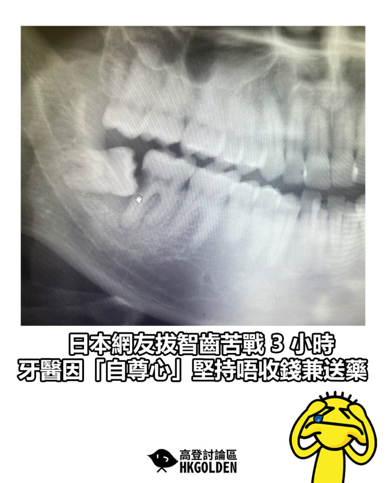 【日本網友拔智齒苦戰 3 小時　牙醫因「自尊心」堅持唔收錢兼送藥】