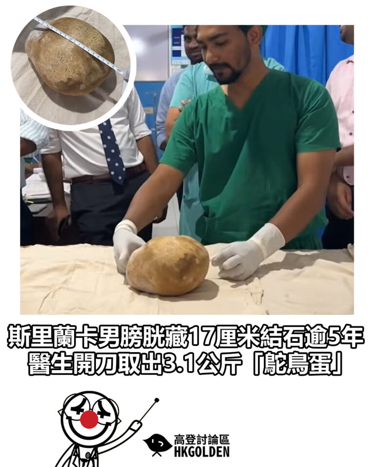 【斯里蘭卡男膀胱藏17厘米結石逾5年 醫生開刀取出3.1公斤「鴕鳥蛋」】
